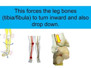 This forces the leg bones
(tibia/fibula) to turn inward and also
               drop down.
 