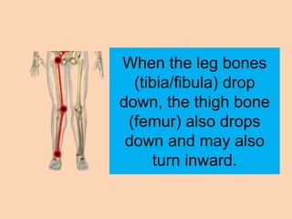 When the leg bones
  (tibia/fibula) drop
down, the thigh bone
 (femur) also drops
 down and may also
      turn inward.
 