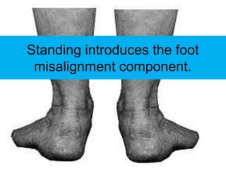 Standing introduces the foot
 misalignment component.
 