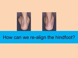 How can we re-align the hindfoot?
 