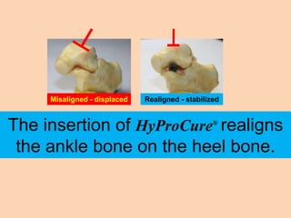 Misaligned - displaced   Realigned - stabilized


The insertion of HyProCure realigns               ®



 the ankle bone on the heel bone.
 