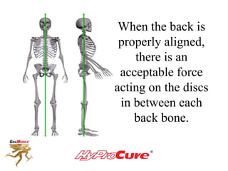 When the back is
properly aligned,
there is an
acceptable force
acting on the discs
in between each
back bone.
 