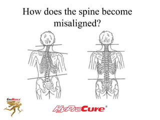 How does the spine become
misaligned?
 