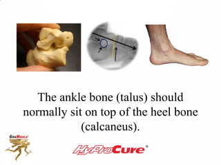 The ankle bone (talus) should
normally sit on top of the heel bone
(calcaneus).
 