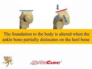 The foundation to the body is altered when the
ankle bone partially dislocates on the heel bone
 