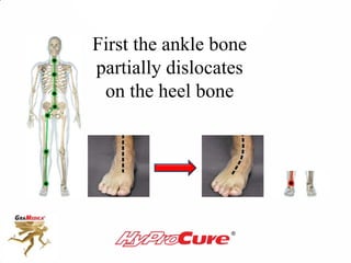 First the ankle bone
partially dislocates
on the heel bone
 