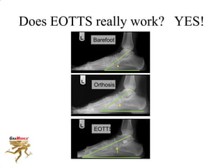 Does EOTTS really work? YES!
Barefoot
Orthosis
EOTTS
 