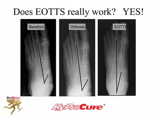 Barefoot Orthosis EOTTS
Does EOTTS really work? YES!
 