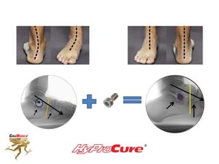 Back Pain - It All Starts Here