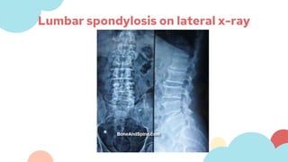 Lumbar spondylosis on lateral x-ray
 