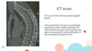 •CT scan of the thoracic spine (sagittal
plane)
•Characteristic changes in ankylosing
spondylitis with syndesmophytes (1),
subchondral sclerosis (red overlay), disc
space narrowing (2), and ossification of
the supraspinous ligament (3).
CT scan
 