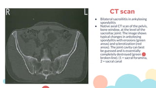 ● Bilateral sacroiliitis in ankylosing
spondylitis
● Native axial CT scan of the pelvis,
bone window, at the level of the
sacroiliac joint: The image shows
typical changes in ankylosing
spondylitis with erosions (green
areas) and sclerotization (red
areas). The joint cavity can best
be guessed and is essentially
completely destroyed (green
broken line). (1 = sacral foramina,
2 = sacral canal
CT scan
 