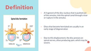 ● A fragment of the disc nucleus that is pushed out
of the annulus, into the spinal canal through a tear
or rupture in the annulus.
● Discs that become herniated are usually in an
early stage of degeneration
● Due to this displacement, the disc presses on
spinal nerves, often producing pain, which may be
severe.
Definition
 
