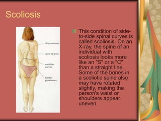 Scoliosis
This condition of side-
to-side spinal curves is
called scoliosis. On an
X-ray, the spine of an
individual with
scoliosis looks more
like an "S" or a "C"
than a straight line.
Some of the bones in
a scoliotic spine also
may have rotated
slightly, making the
person's waist or
shoulders appear
uneven.
 