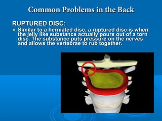 Common Problems in the BackCommon Problems in the Back
RUPTURED DISC:RUPTURED DISC:
♦ Similar to a herniated disc, a ruptured disc is whenSimilar to a herniated disc, a ruptured disc is when
the jelly like substance actually pours out of a tornthe jelly like substance actually pours out of a torn
disc. The substance puts pressure on the nervesdisc. The substance puts pressure on the nerves
and allows the vertebrae to rub together.and allows the vertebrae to rub together.
 