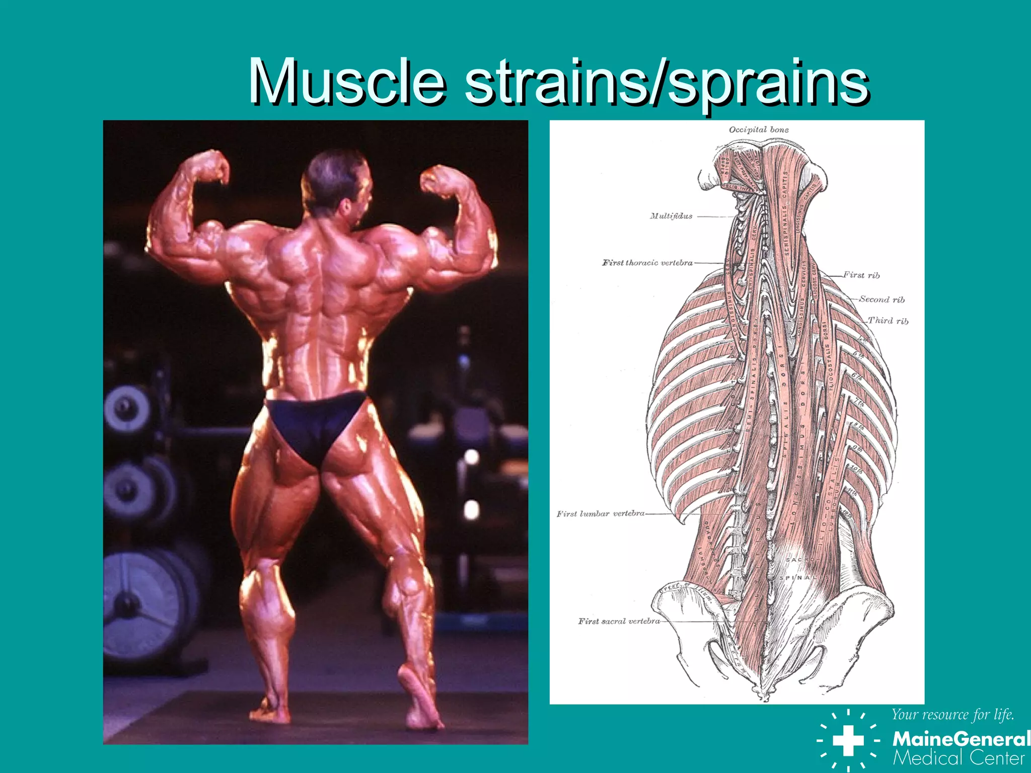 Muscle strains/sprainsMuscle strains/sprains
 