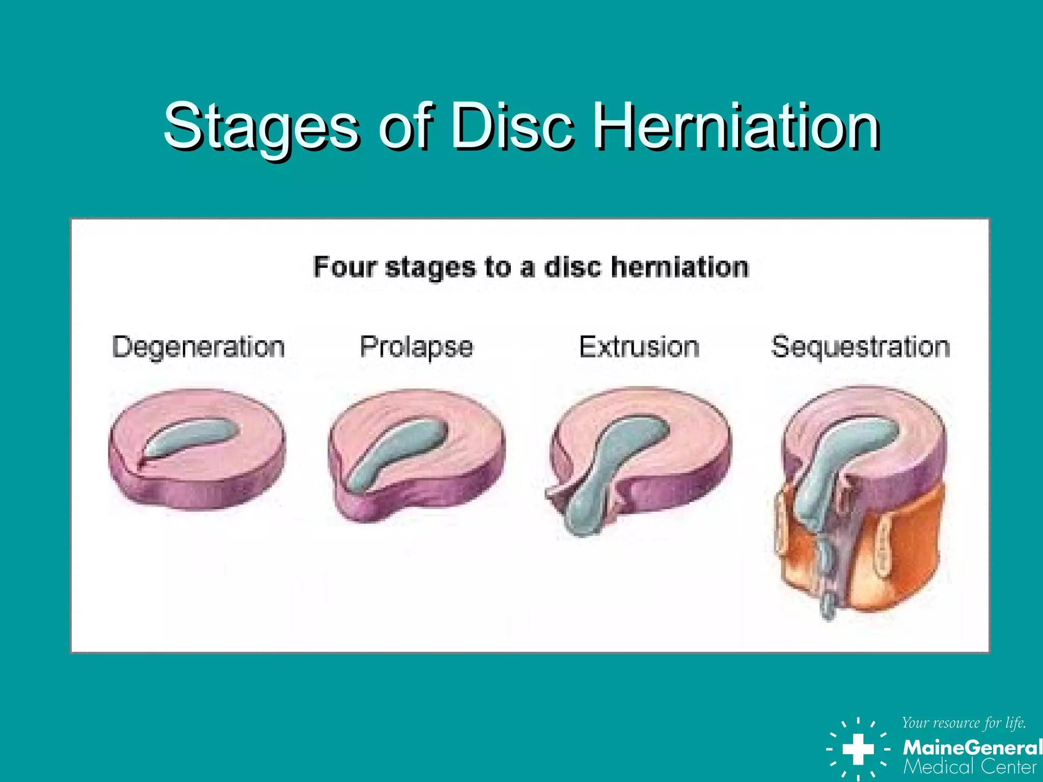 Stages of Disc HerniationStages of Disc Herniation
 