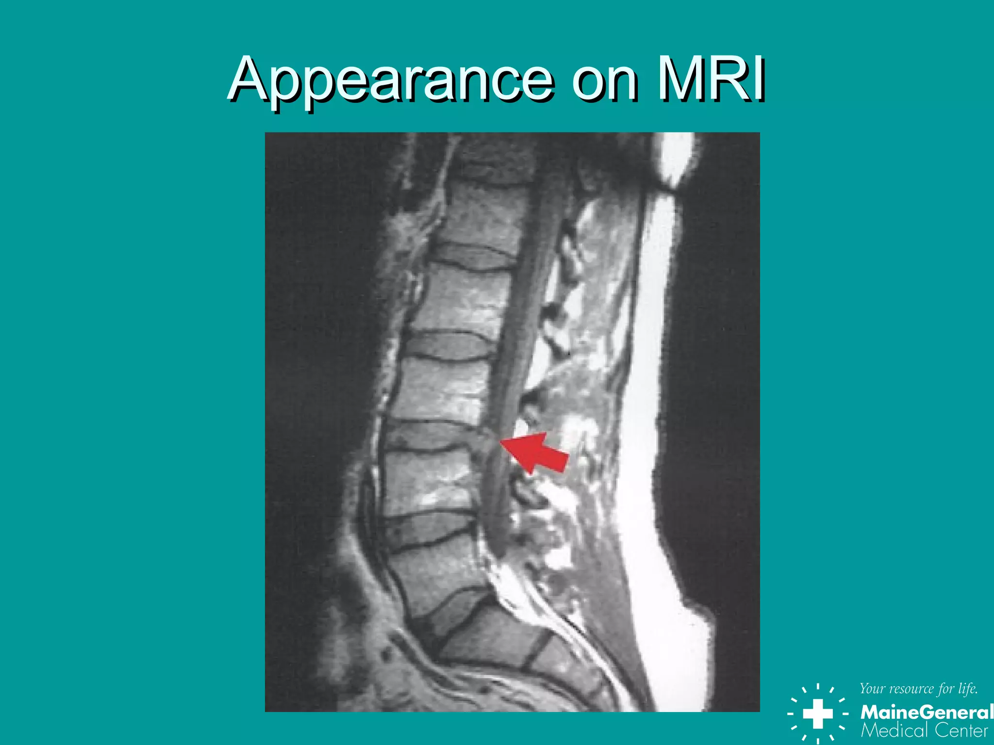 Appearance on MRIAppearance on MRI
 