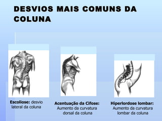 DESVIOS MAIS COMUNS DA COLUNA Escoliose:  desvio lateral da coluna Acentuação da Cifose:   Aumento da curvatura  dorsal da coluna Hiperlordose lombar:   Aumento da curvatura lombar da coluna                                                   