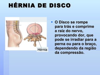 HÉRNIA DE DISCO O Disco se rompe para trás e comprime a raiz do nervo, provocando dor, que pode se irradiar para a perna ou para o braço, dependendo da região da compressão. Hérnia 