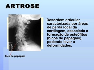 ARTROSE Desordem articular caracterizada por áreas de perda local da cartilagem, associada a formação de osteófitos (bicos de papagaio), podendo levar a deformidades. Bico de papagaio 