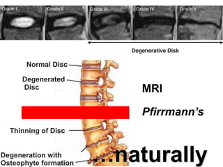 MRI
Pfirrmann’s
…naturally
 