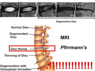 MRI
Pfirrmann’s
…!!!!!!!!!!!!!!
 