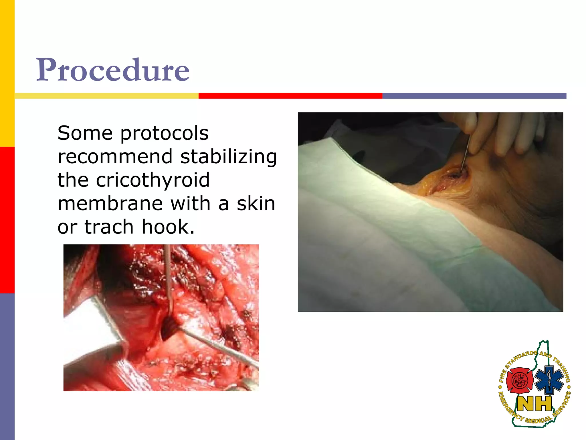 Procedure
Some protocols
recommend stabilizing
the cricothyroid
membrane with a skin
or trach hook.
 