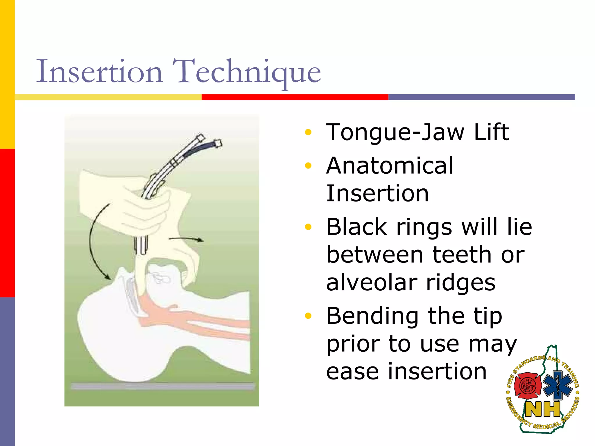 Insertion Technique
• Tongue-Jaw Lift
• Anatomical
Insertion
• Black rings will lie
between teeth or
alveolar ridges
• Bending the tip
prior to use may
ease insertion
 