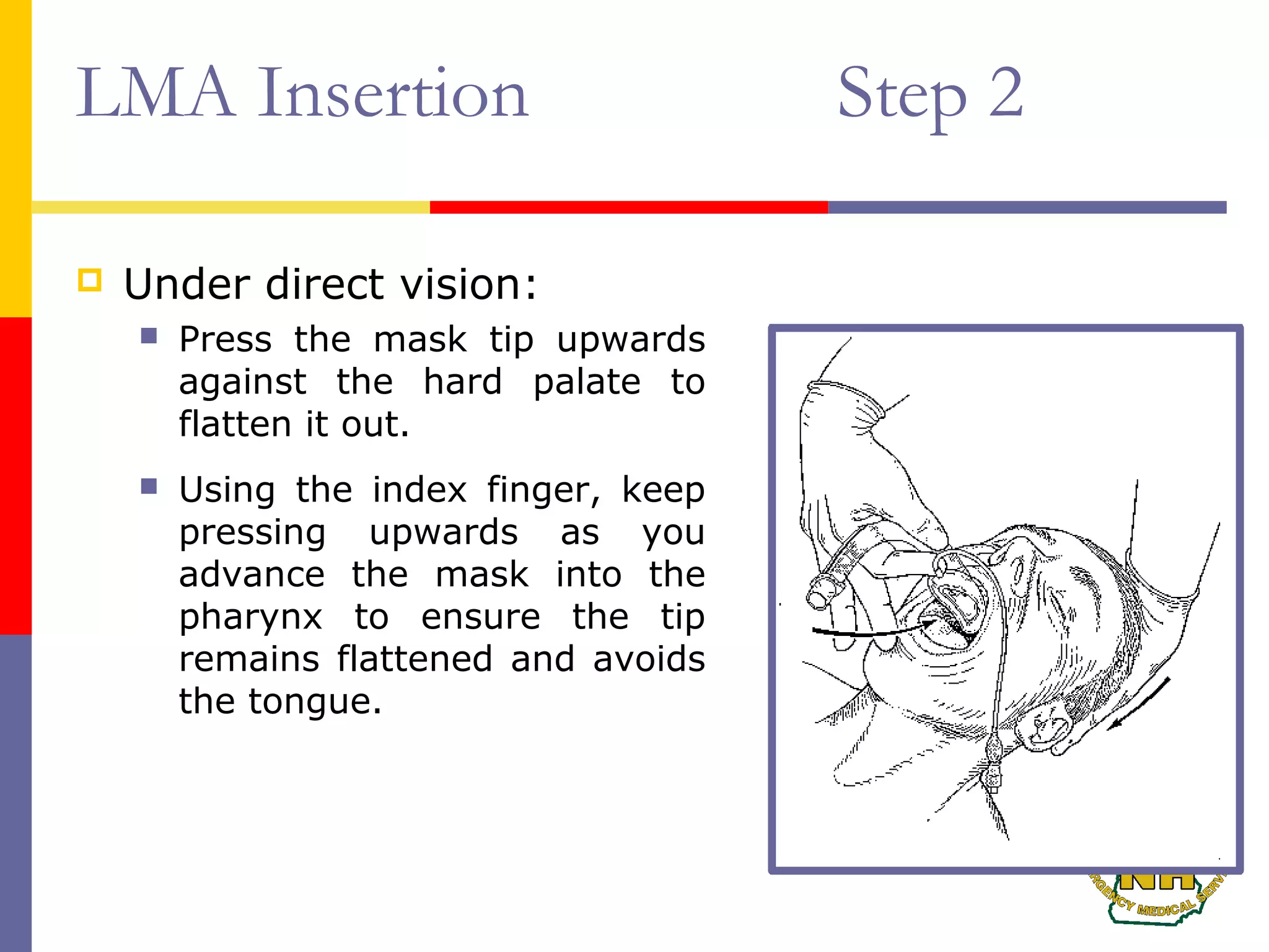 LMA Insertion Step 2
 Under direct vision:
 Press the mask tip upwards
against the hard palate to
flatten it out.
 Using the index finger, keep
pressing upwards as you
advance the mask into the
pharynx to ensure the tip
remains flattened and avoids
the tongue.
 