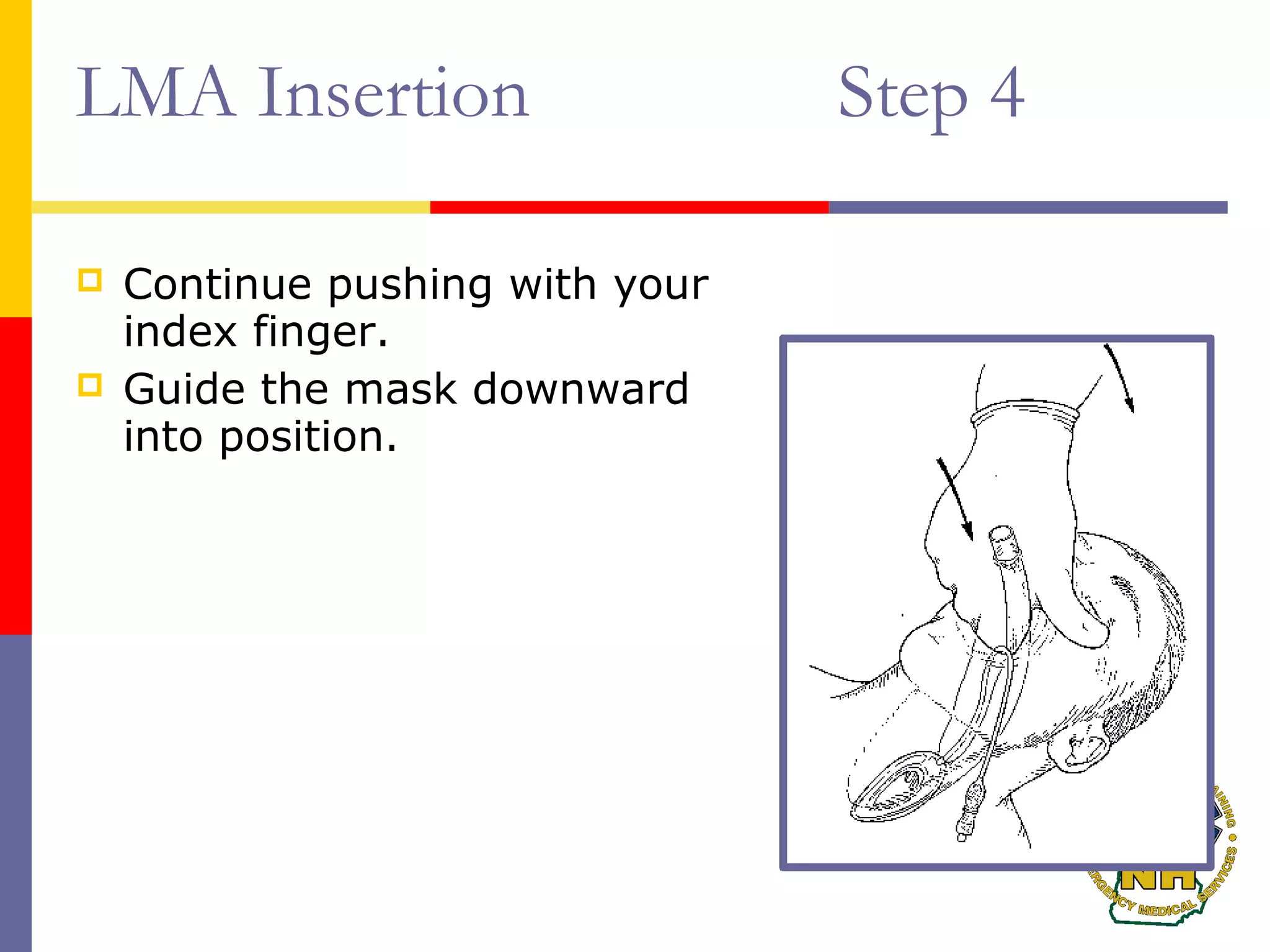 LMA Insertion Step 4
 Continue pushing with your
index finger.
 Guide the mask downward
into position.
 