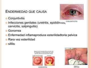 ENDERMEDAD QUE CAUSA
 Conjuntivitis
 Infecciones genitales (uretritis, epididimitis,
cervicitis, salpinguitis)
 Gonorrea
 Enfermedad inflamaproduce esterilidadtoria pelvica
 Rara vez esterilidad
 sifilis
 
