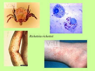 Rickettsia   rickettsii   