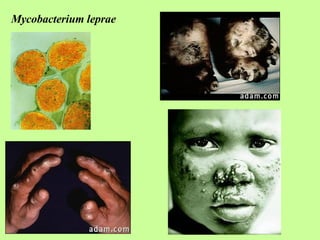 Mycobacterium leprae 