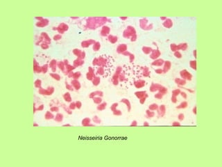 Neisseiria Gonorrae 