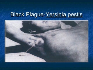 Black Plague-Black Plague-YersiniaYersinia pestispestis
 