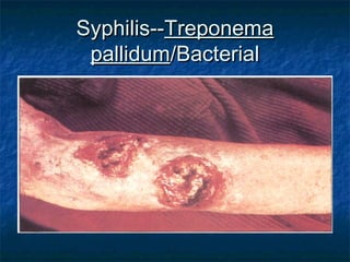 Syphilis--Syphilis--TreponemaTreponema
pallidumpallidum/Bacterial/Bacterial
 
