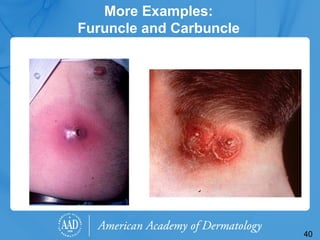 Carbuncle Examples Bacterial-Skin-Infecffgydhytfytytftyftftytions.pptx