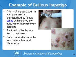 Bullous Face Bacterial-Skin-Infecffgydhytfytytftyftftytions.pptx