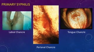 PRIMARY SYPHILIS
Labial Chancre
Perianal Chancre
Tongue Chancre
 
