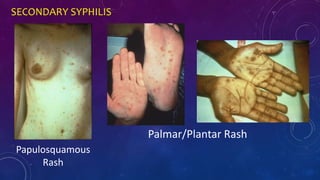 SECONDARY SYPHILIS
Papulosquamous
Rash
Palmar/Plantar Rash
 
