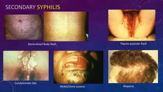 SECONDARY SYPHILIS
Nickel/Dime Lesions
Condylomata lata
Alopecia
Generalized Body Rash Papulo-pustular Rash
 