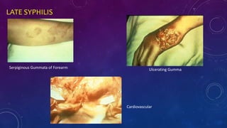 LATE SYPHILIS
Ulcerating GummaSerpiginous Gummata of Forearm
Cardiovascular
 