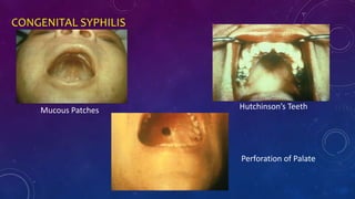 CONGENITAL SYPHILIS
Mucous Patches Hutchinson’s Teeth
Perforation of Palate
 
