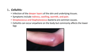 bacterial-and-fungal-skin-diseases-pptx