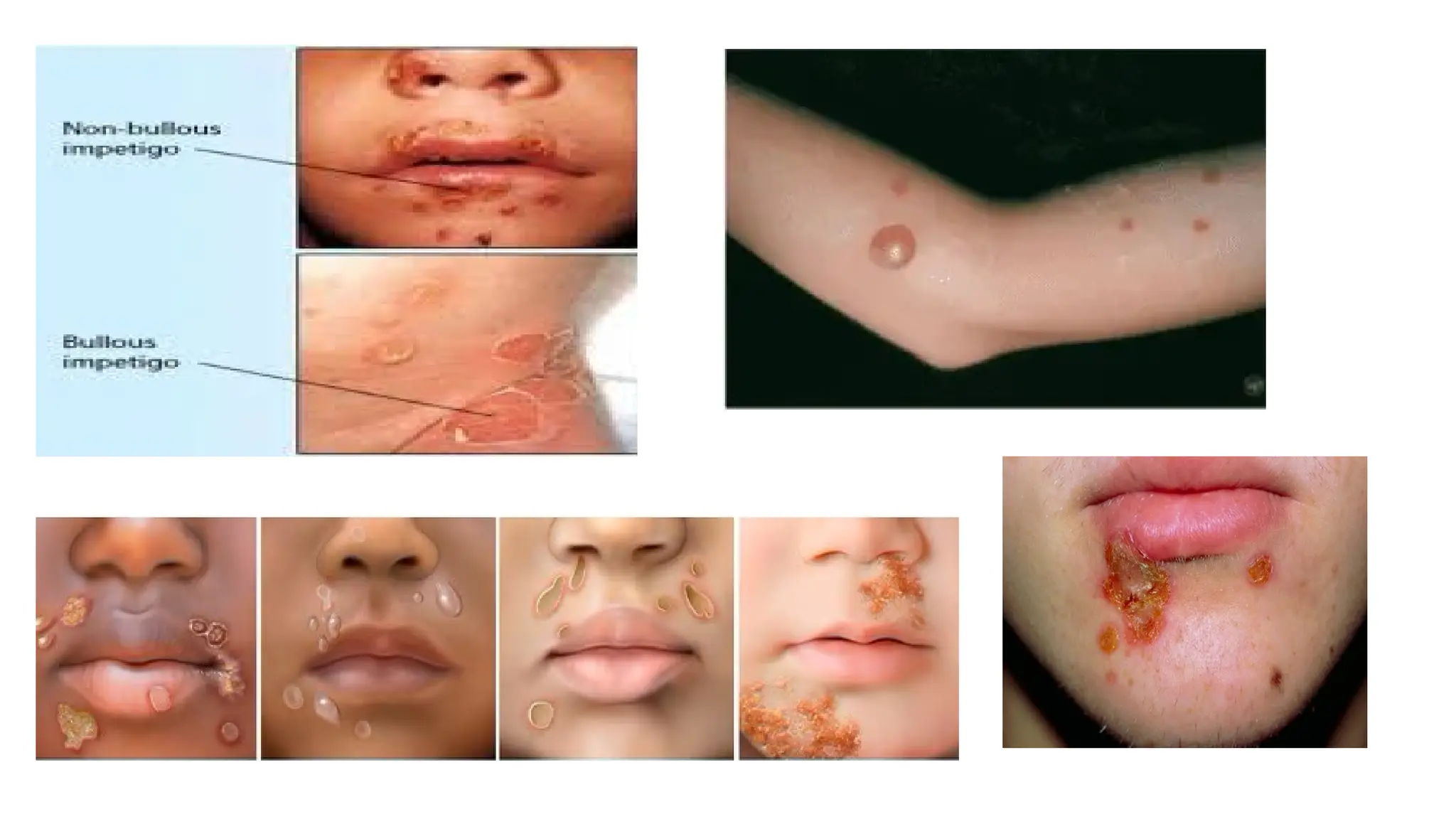 bacterial and viral skin infections - ppt | PPTX
