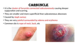 bacterial and viral skin infections - ppt | PPTX