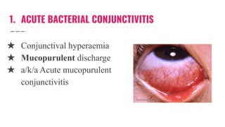 1. ACUTE BACTERIAL CONJUNCTIVITIS
★ Conjunctival hyperaemia
★ Mucopurulent discharge
★ a/k/a Acute mucopurulent
conjunctivitis
 