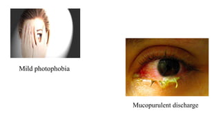 Mild photophobia
Mucopurulent discharge
 