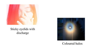 Sticky eyelids with
discharge
Coloured halos
 